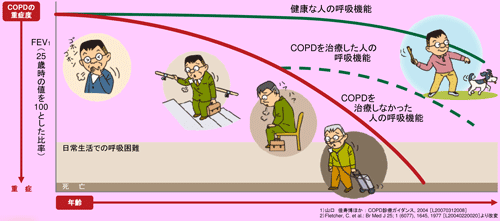 ある copd ある その息苦しさは肺気腫（COPD）が原因!?知っておくべき7つの事実